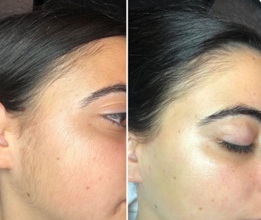 Laser Hair Reduction Results